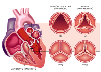 Bệnh viện FV tiên phong ứng dụng công nghệ thay van động mạch chủ thế hệ mới nhất